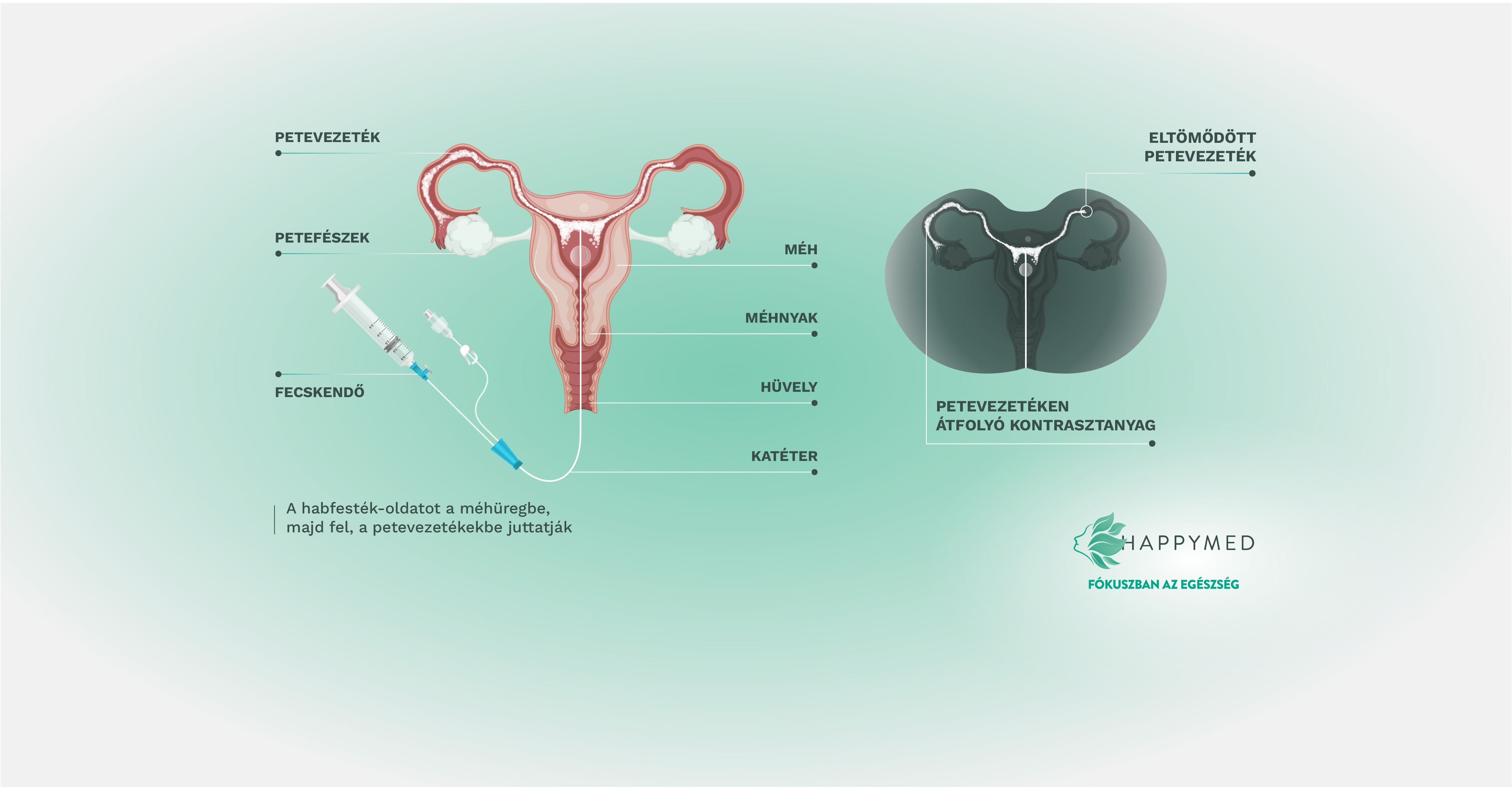 HyCoSy- ultrahangos petevezeték átjárhatósági vizsgálat - Happymed